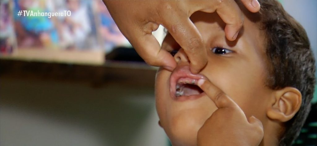 Menino que precisa extrair todos os dentes tem dificuldade para se alimentar e beber água, diz mãe