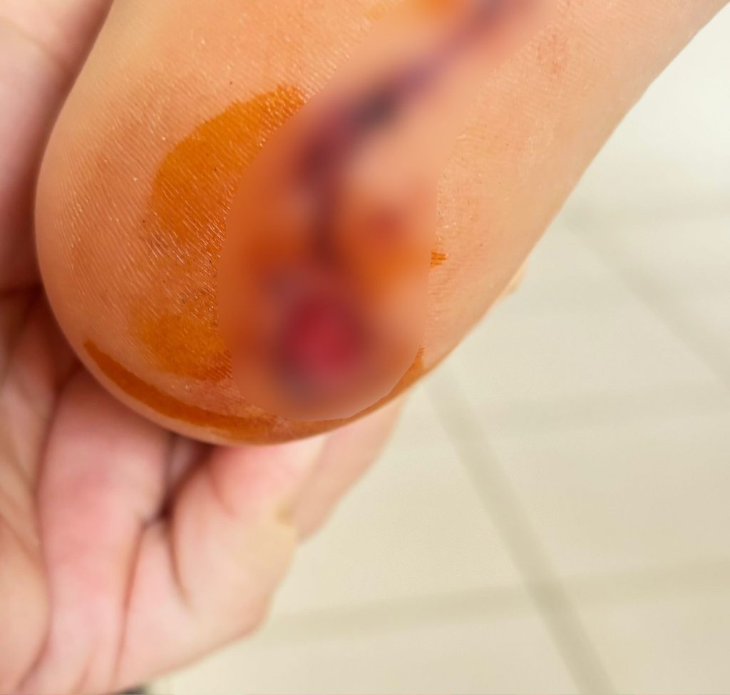Criança fica ferida após ataque de piranha em praia de Palmas e mãe reclama: ‘Ninguém para dar suporte’