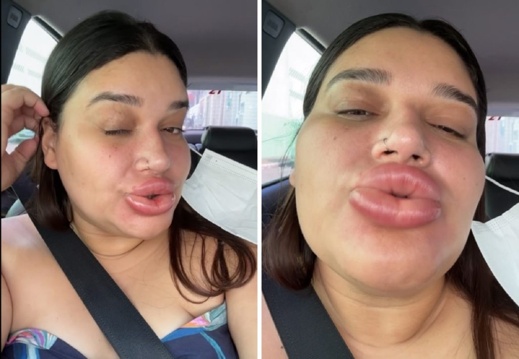 Maquiadora fica com lábios gigantes após retirar preenchimento labial e viraliza ao rir da situação: ‘Lindíssima’